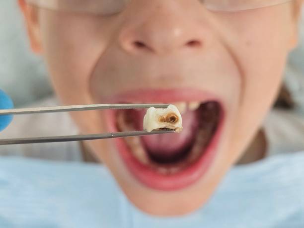 Best Emergency Tooth Extraction in Hermiston, OR